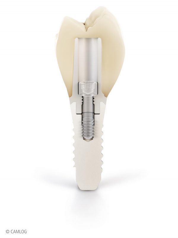 Keramik Implantat